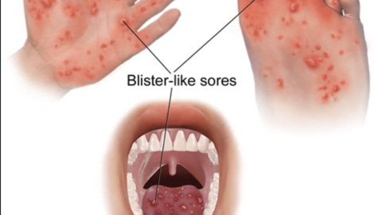 Hand Foot and Mouth Disease